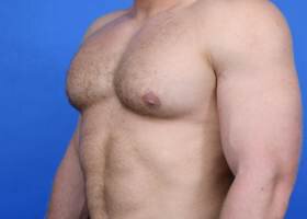 Gynecomastia Surgery muscular patient After