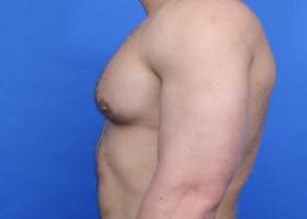 Gynecomastia Surgery muscular patient After