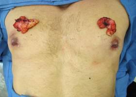 Glands removed in Gynecomastia surgery