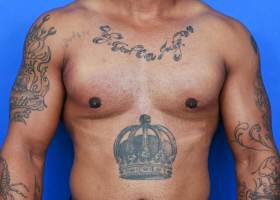 Austin Gynecomastia Surgery well-built patient After