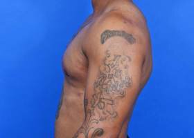Gynecomastia Surgery well-built patient After