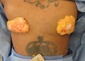 Glands removed during gynecomastia surgery