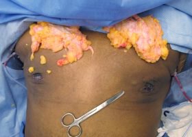 Glands and tissue removed during Gynecomastia surgery