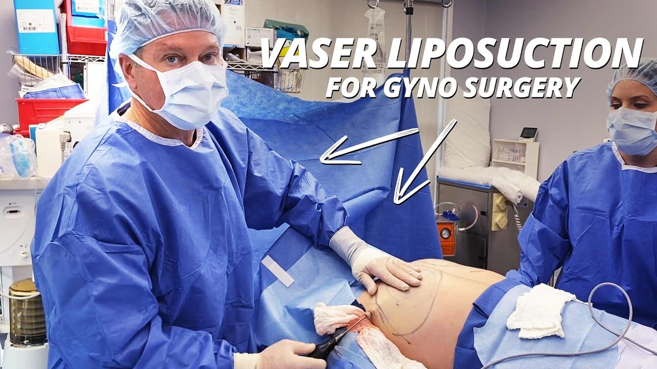 Vaser liposuction for Gynecomastia video