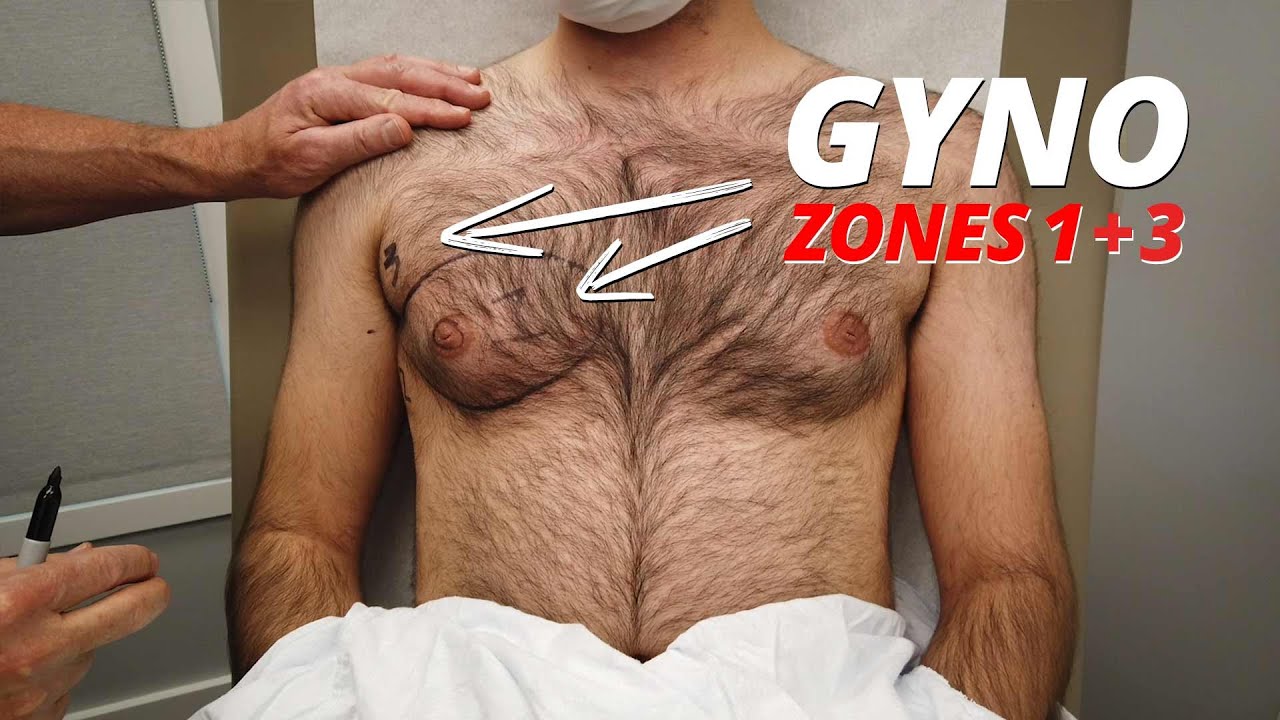 Three zones for Gynecomastia video