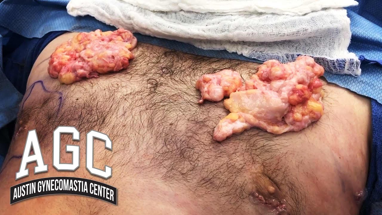 AGC glands removed video