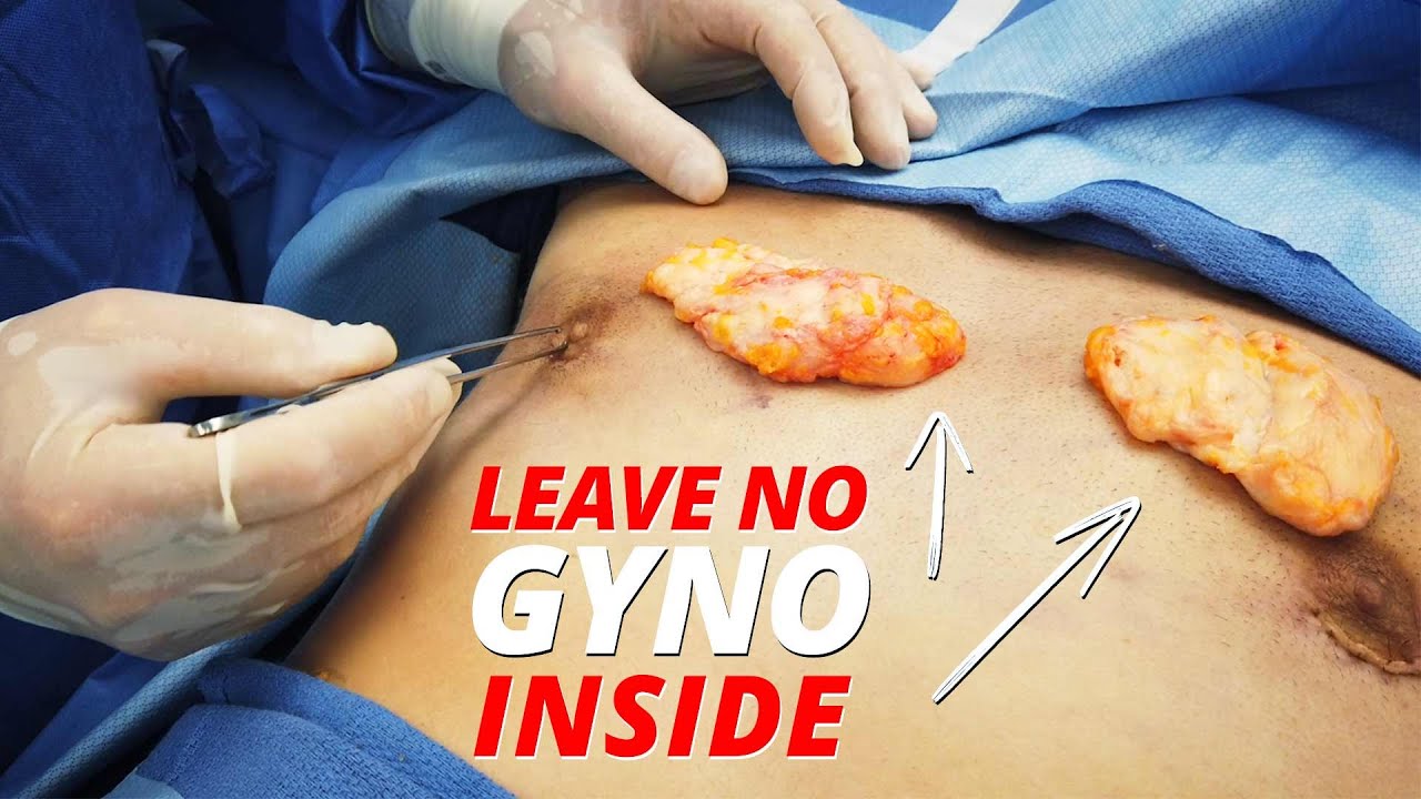 Leave no Gynecomastia inside video