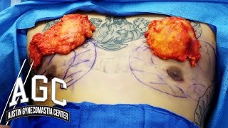 After Gynecomastia surgery male breast reduction video