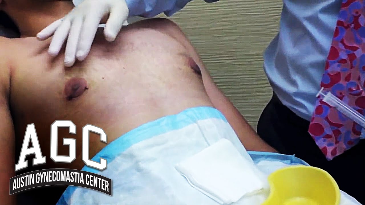 Excess fluid after Gynecomastia surgery video