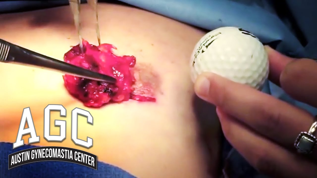 Golf ball gynecomastia video