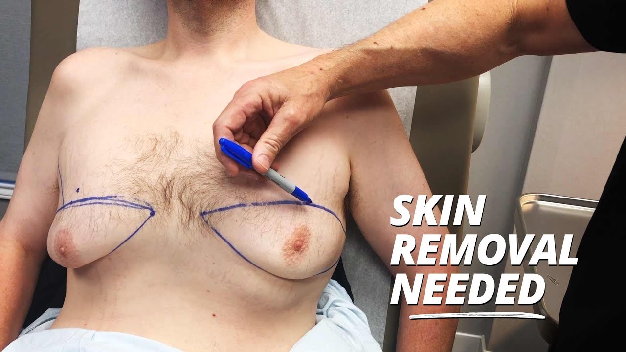 Skin removal needed video