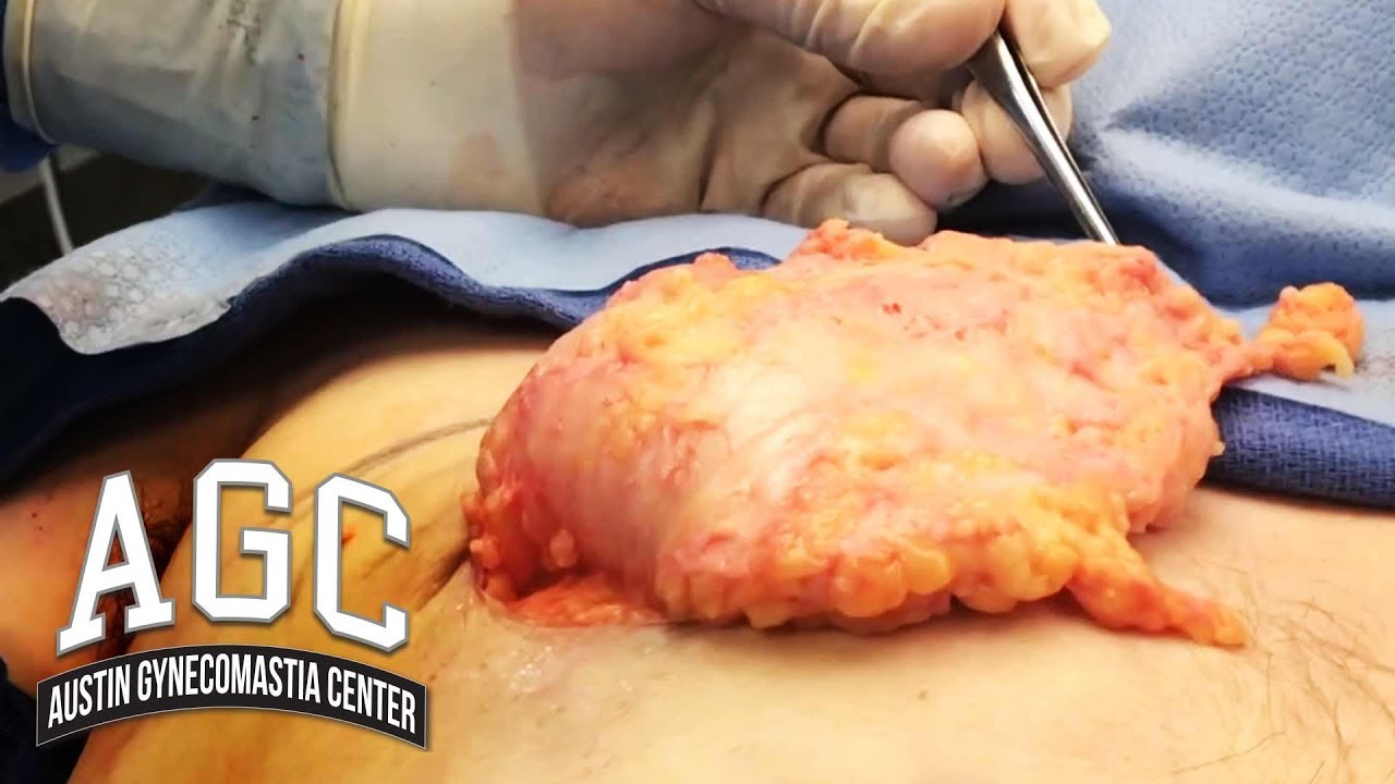 Fat and tissue removed in gynecomastia surgery video