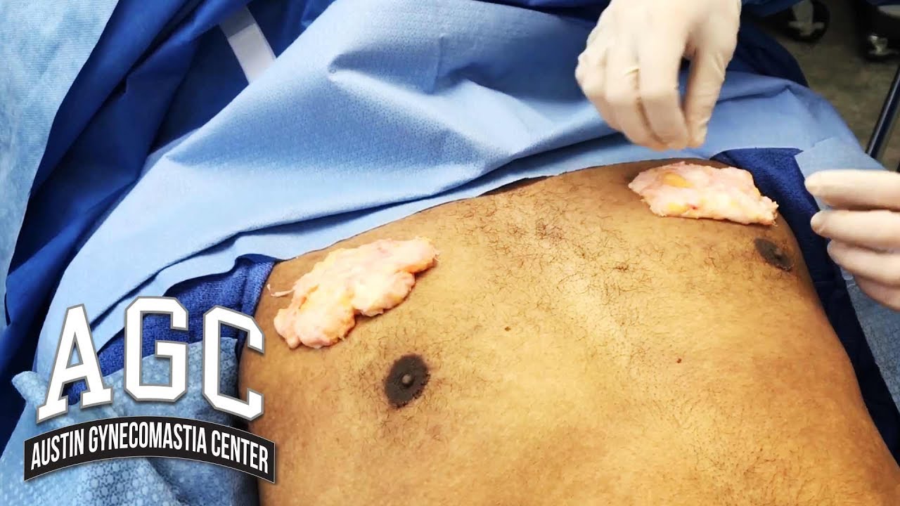 Removing glands in Gynecomastia surgery video