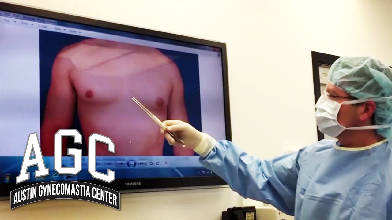 One-sided gynecomastia video