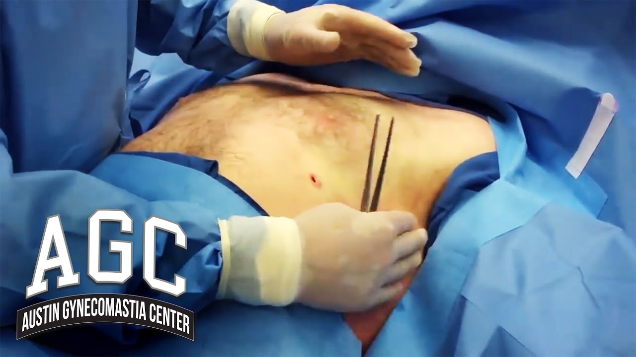 Chest contouring in gynecomastia treatment video
