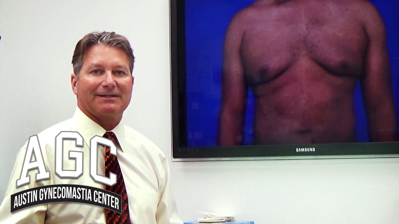 Is it gynecomastia or fat? Video