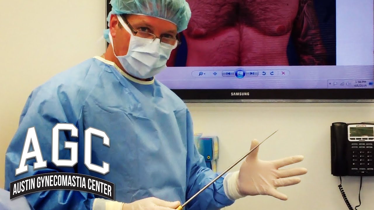 Pleating technique on gynecomastia patient video
