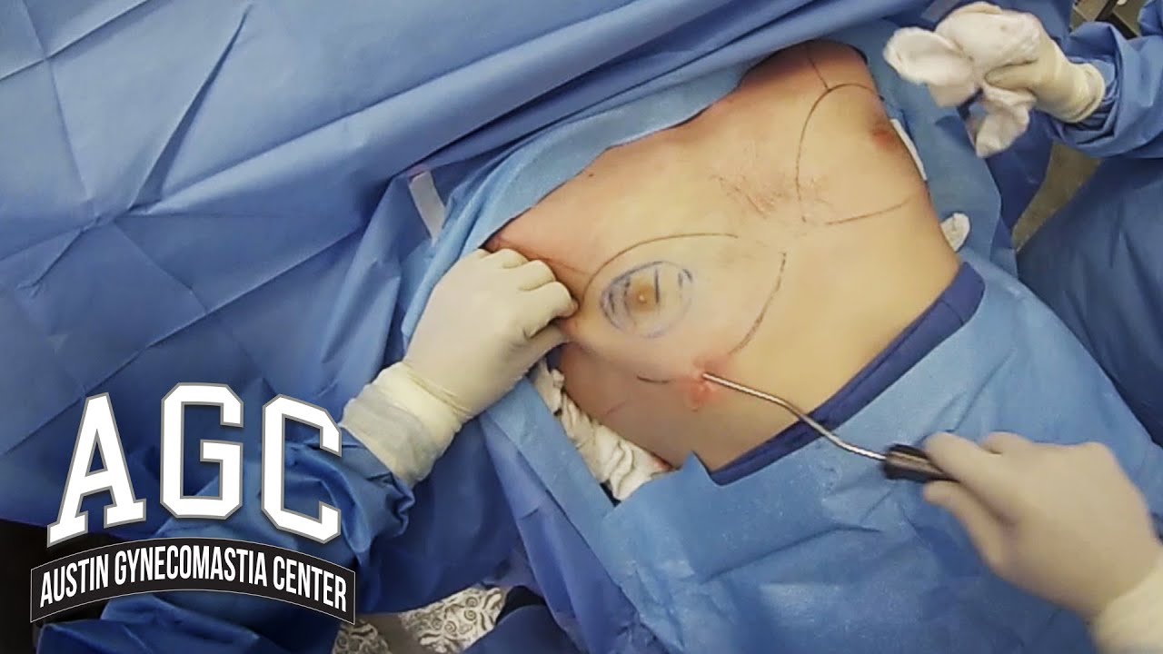 Gynecomastia removal surgery video