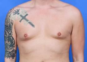 Gynecomastia Surgery  Before & After Image