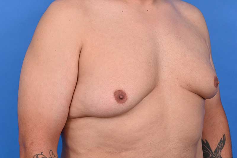 Gynecomastia Surgery Before & After Image