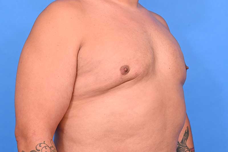 Gynecomastia Surgery Before & After Image