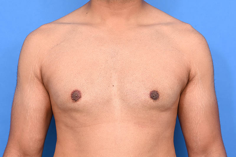 Gynecomastia Surgery Before & After Image