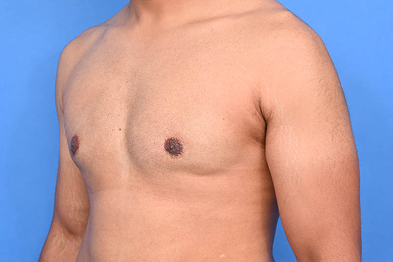 Gynecomastia Surgery Before & After Image