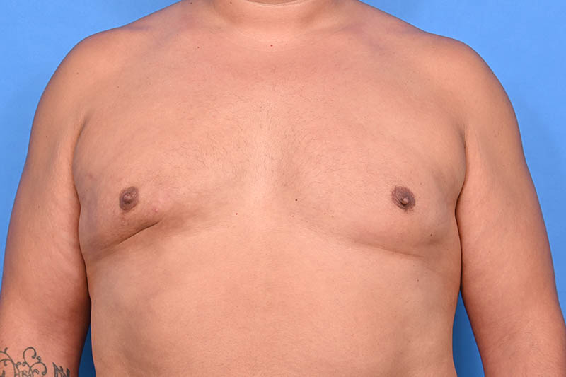 Gynecomastia Surgery Before & After Image