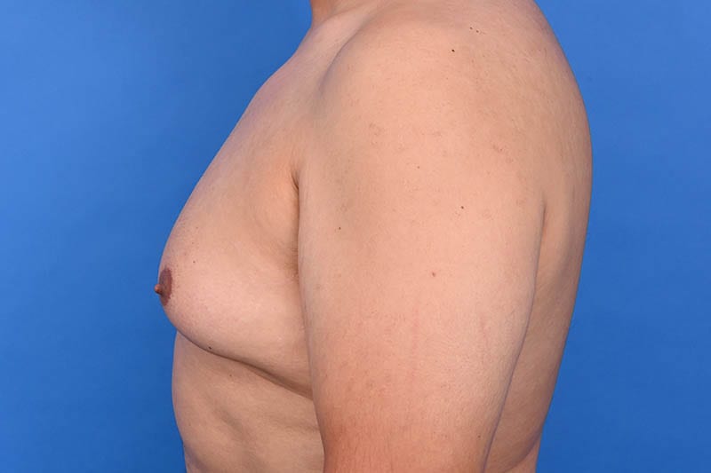 Gynecomastia Surgery Before & After Image