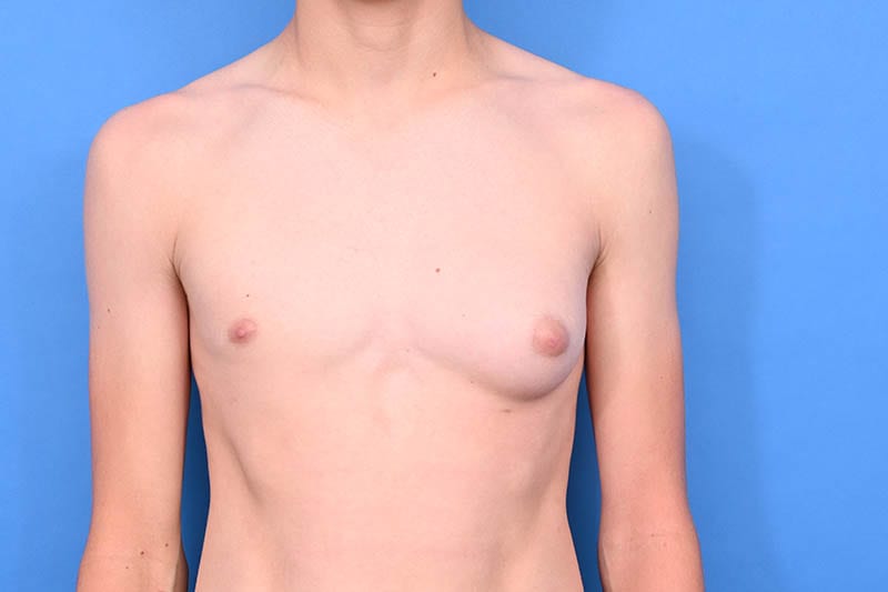 Gynecomastia Surgery Before & After Image