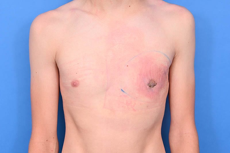 Gynecomastia Surgery Before & After Image