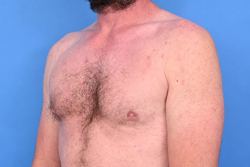 Gynecomastia Surgery Before & After Image