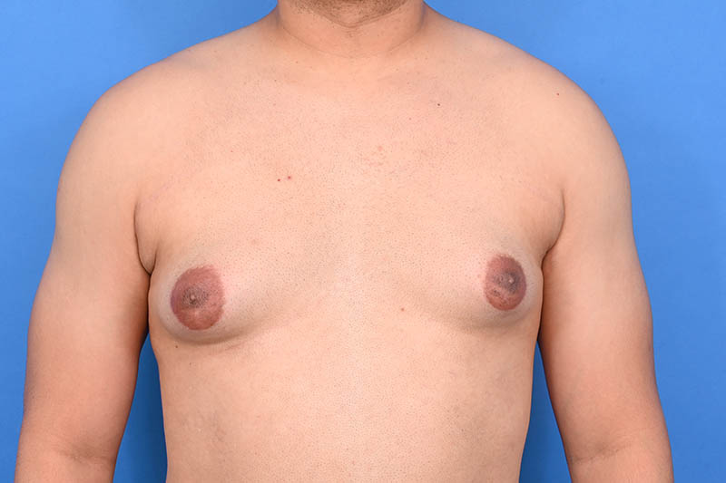 Gynecomastia Surgery Before & After Image