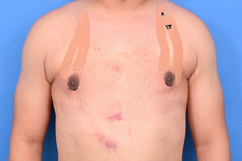 Gynecomastia Surgery Before & After Image