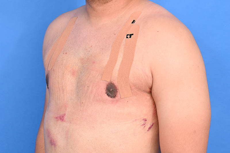 Gynecomastia Surgery Before & After Image