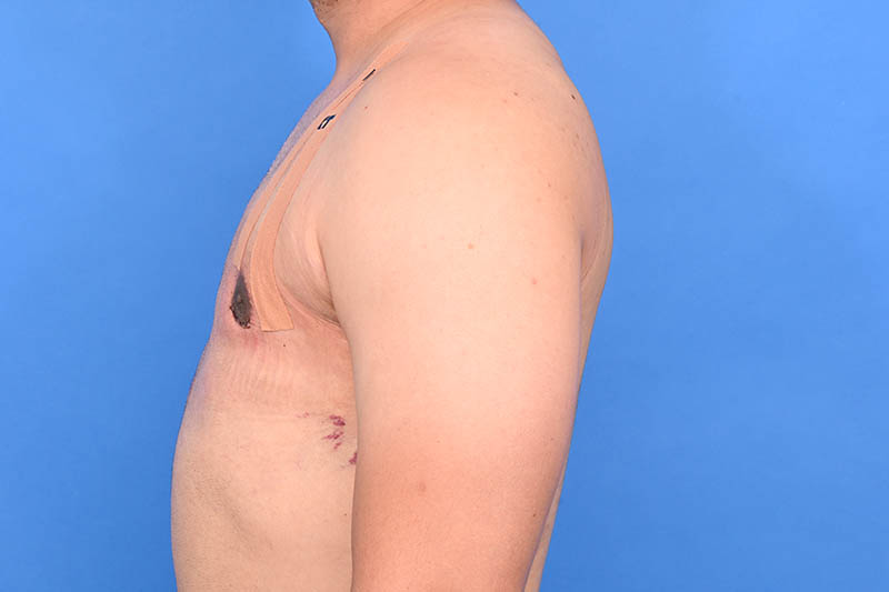 Gynecomastia Surgery Before & After Image