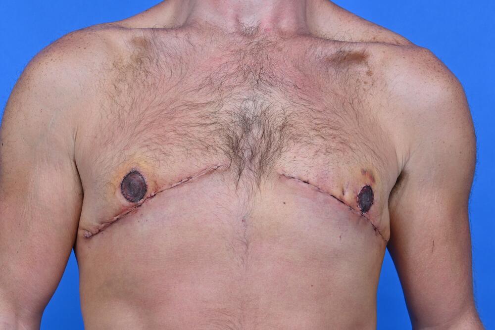 Gynecomastia Surgery Before & After Image