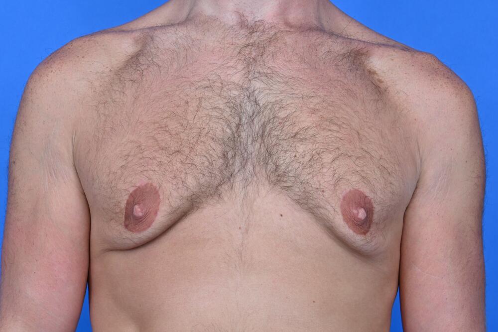 Gynecomastia Surgery Before & After Image