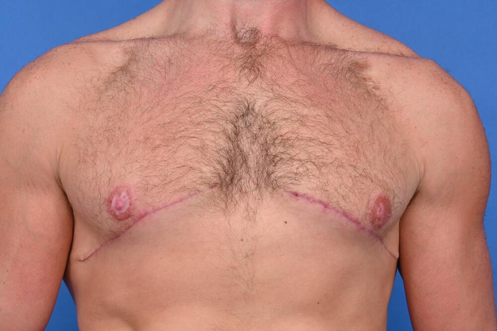 Gynecomastia Surgery Before & After Image