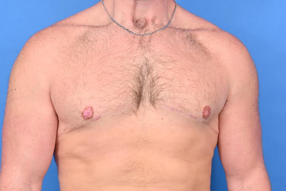 Gynecomastia Surgery Before & After Image