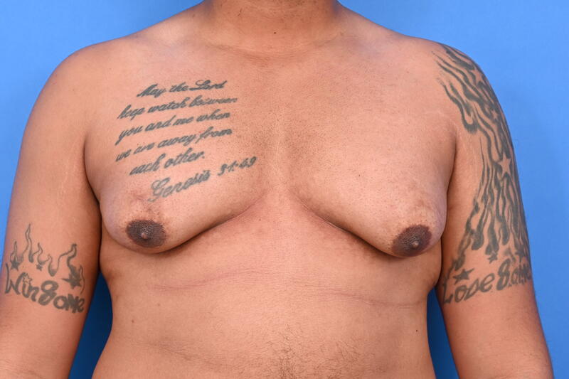 Gynecomastia Surgery Before & After Image