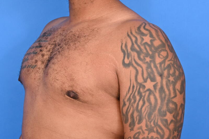 Gynecomastia Surgery Before & After Image