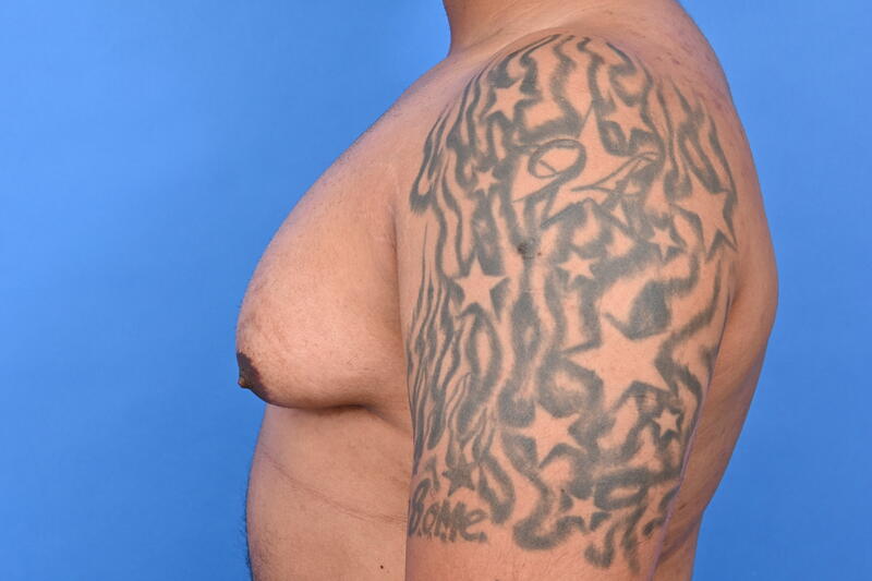 Gynecomastia Surgery Before & After Image