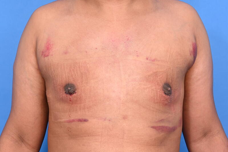 Gynecomastia Surgery Before & After Image