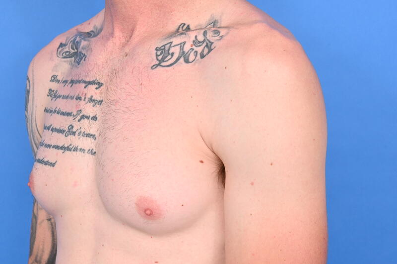 Gynecomastia Surgery Before & After Image