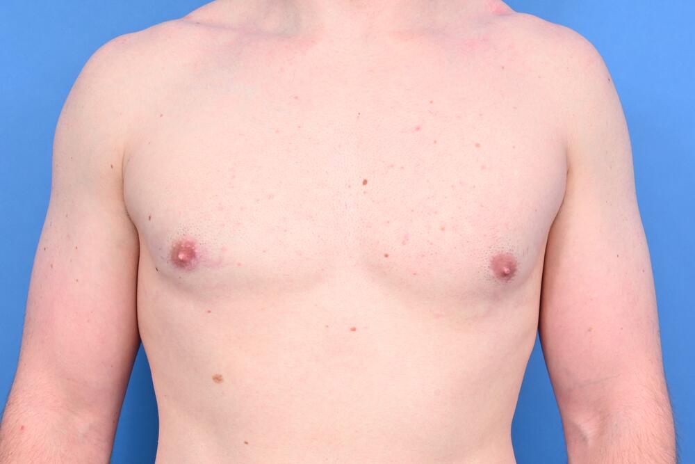 Gynecomastia Surgery Before & After Image