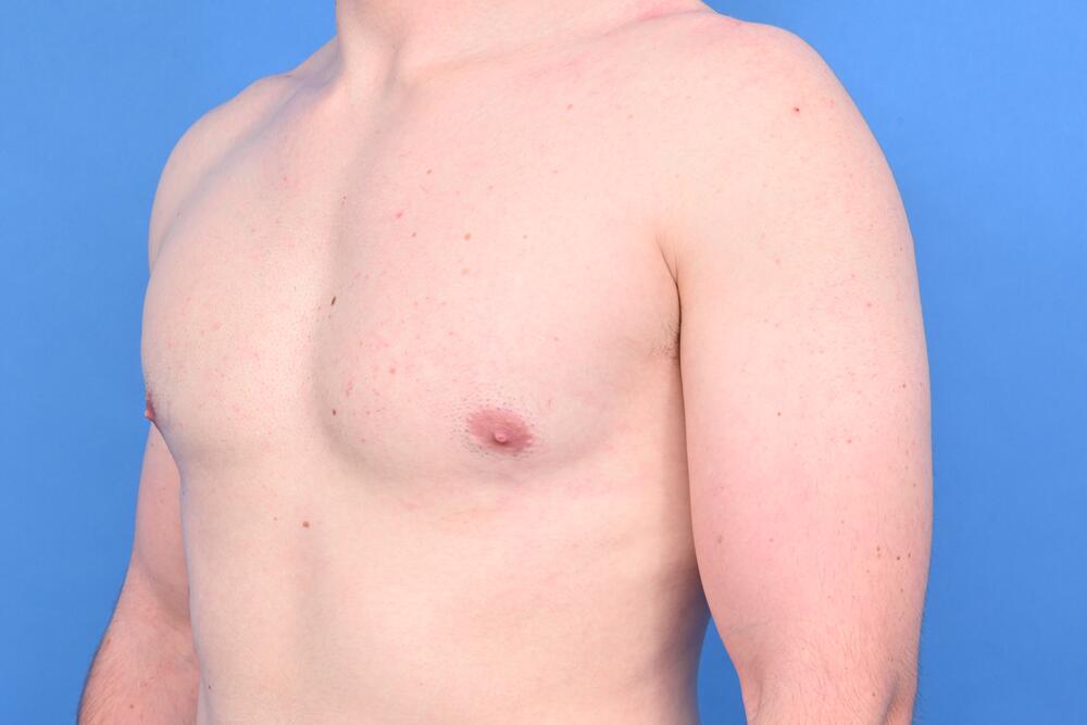 Gynecomastia Surgery Before & After Image