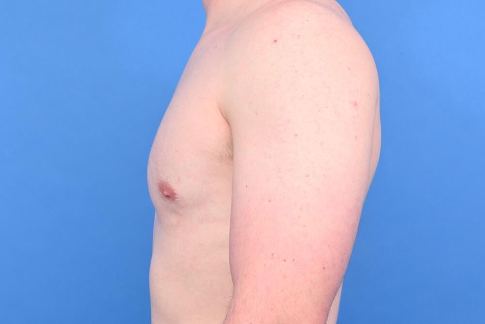 Gynecomastia Surgery Before & After Image