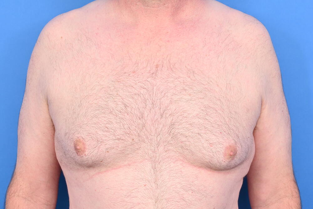 Gynecomastia Surgery Before & After Image