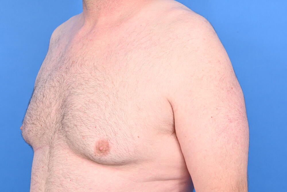 Gynecomastia Surgery Before & After Image